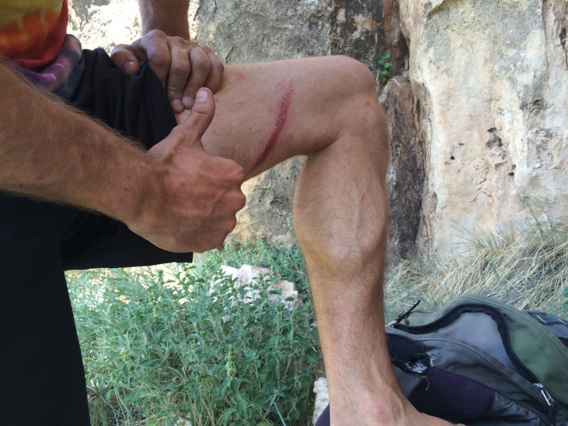 John's rope burn after taking a fall while leading